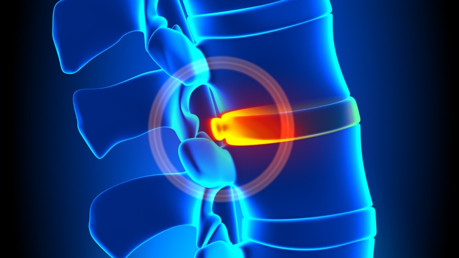 herniated disc 2