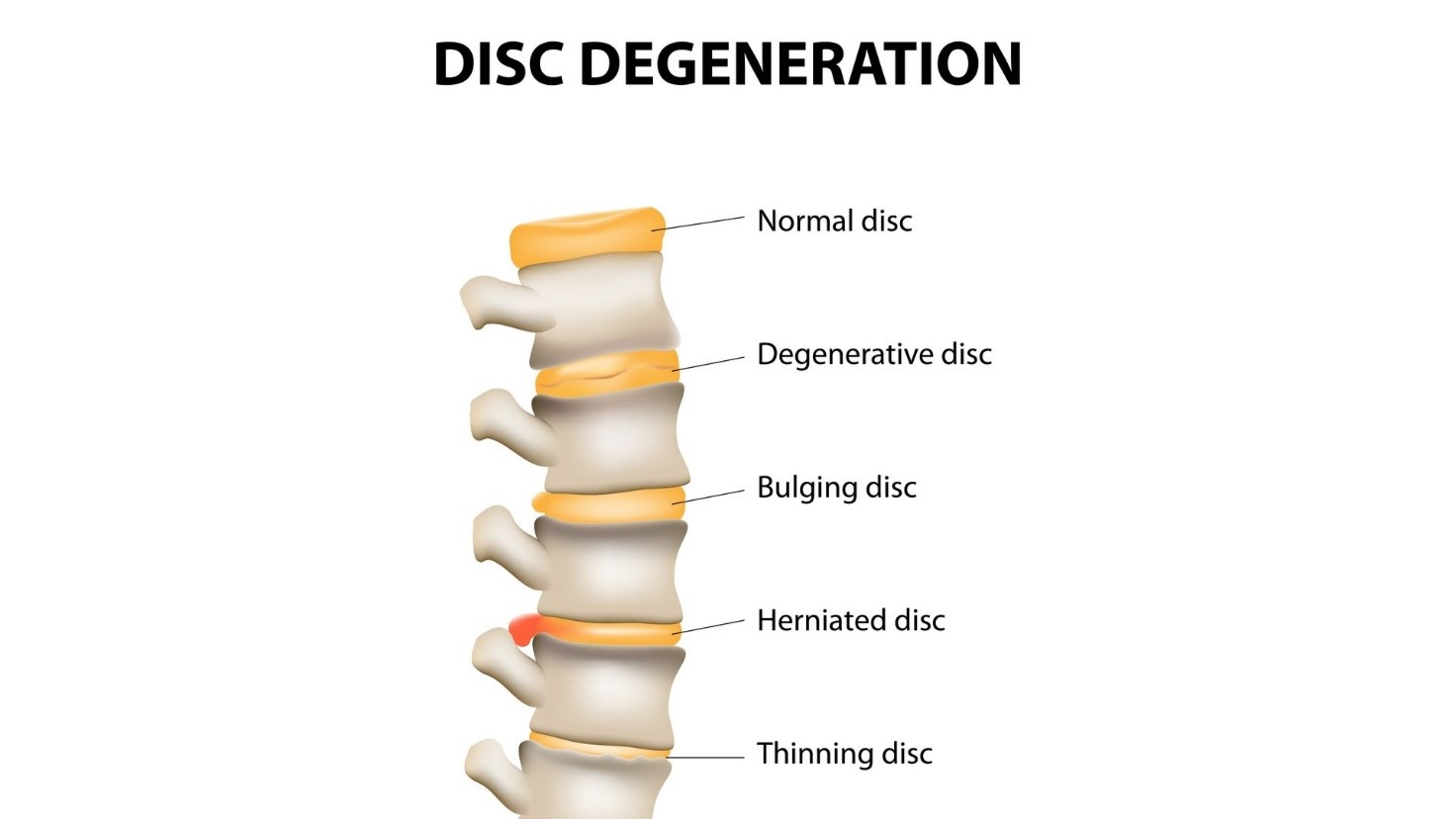 hernidated disc 3