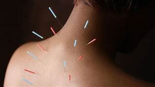 medical acupuncture 1